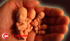 Nạo phá thai gây vô sinh và ung thư cổ tử cung