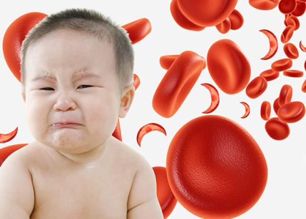 Thiếu máu do thiếu sắt là loại thiếu máu dinh dưỡng hay gặp nhất ở trẻ em