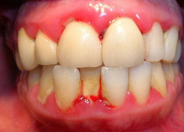 Viêm quanh cuống răng rất dễ dẫn đến áp-xe và hoại tử tủy