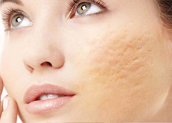 Phương pháp xử lý sẹo và tăng sắc tố da hiệu quả hiện nay