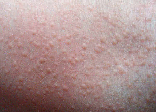 Rôm sảy: Nguyên nhân, dấu hiệu và cách điều trị hiệu quả