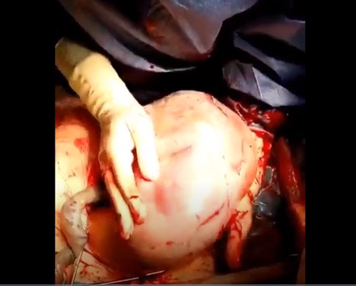 Video quay cảnh đón em bé chào đời trong bọc ối