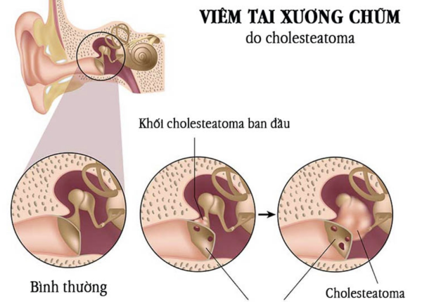 Viêm xương tai chũm là gì? Nguyên nhân, triệu chứng và cách điều trị ra sao?