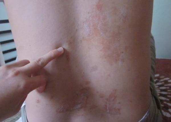 Zona thần kinh nên dùng thuốc gì nhanh khỏi?